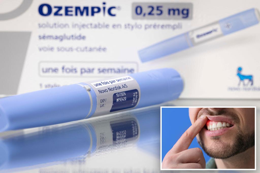'Ozempic teeth' the latest side alarming effect of weight loss medication
