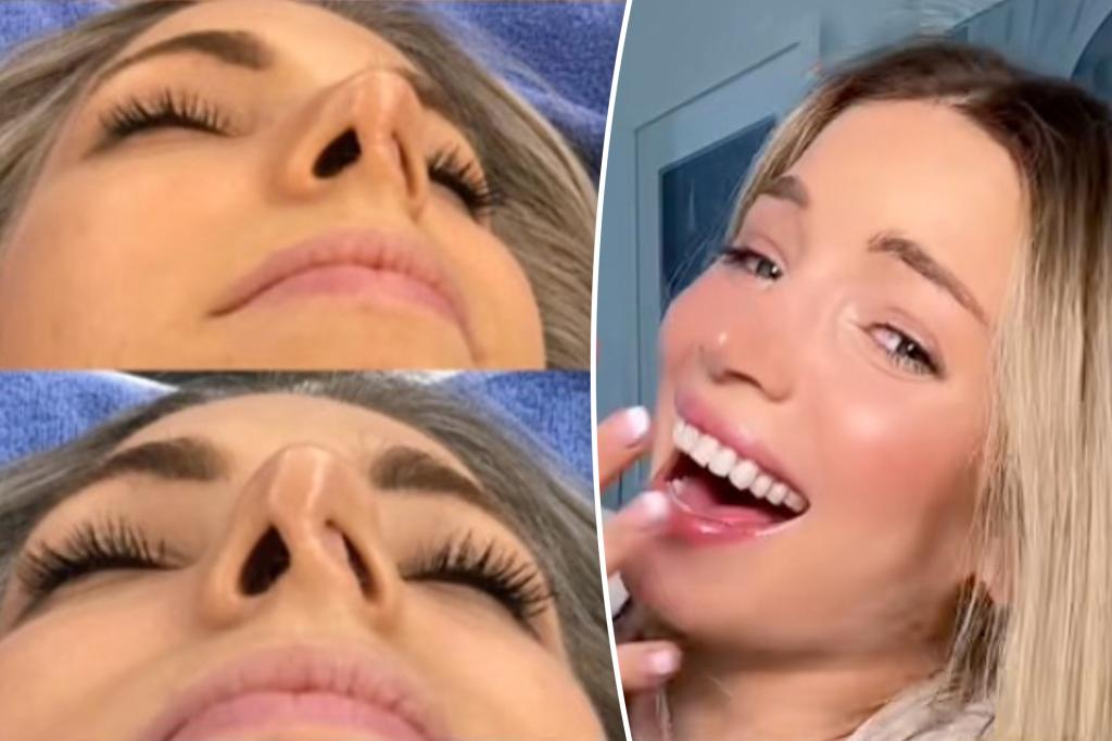 I scored a 'free' nose job - then I got the shock of my life that came with a pricetag $ 26k $