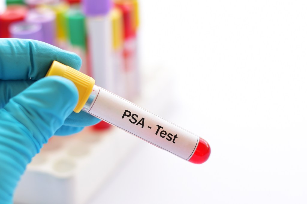 Blood sample for PSA test (specific prostate antigen) for prostate cancer diagnosis